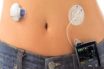 Artificial Pancreas Device System market