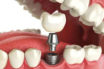 Dental Implants market