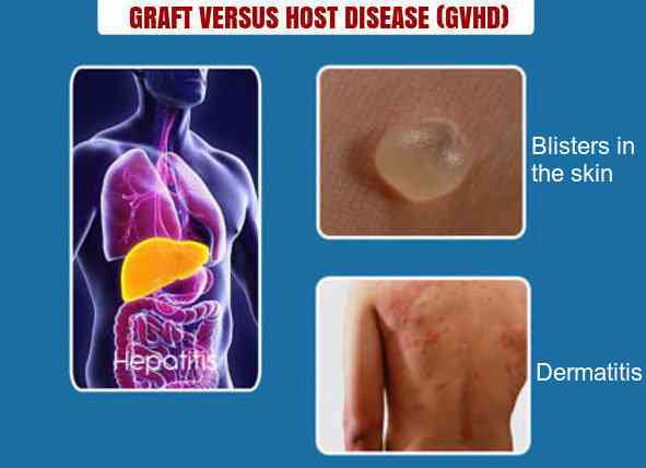 Graft Versus Host Disease (GvHD) Market